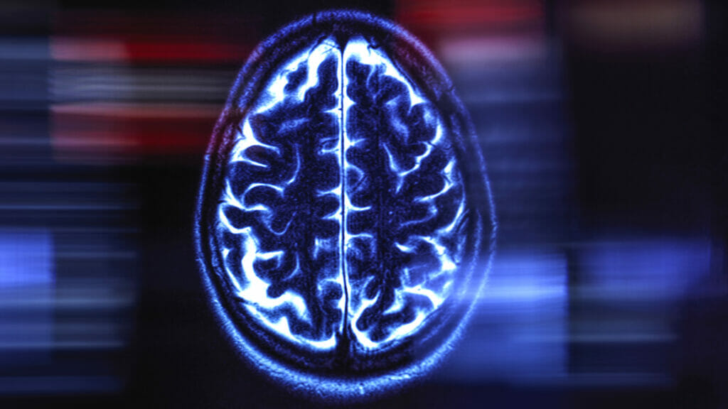 Brain imaging company teases tech that will analyze side effects of new dementia drugs